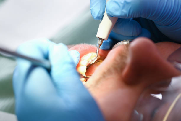 Best Emergency Wisdom Teeth Removal in Hudson Lake, IN